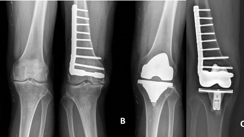 【創傷後膝關節炎】的關節置換不再是夢魘