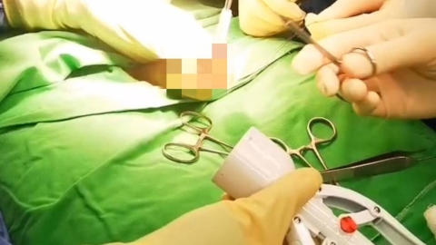 新式包皮槍手術 減少電燒傷害與出血