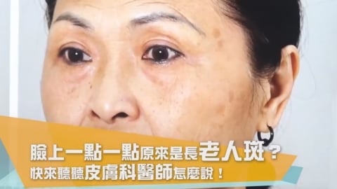 臉上斑點是老人斑?還是肝斑? 皮膚科醫師教您這樣分辨!