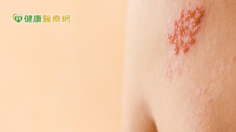 夏天如火狂燒快斬皮蛇！中醫外敷止神經痛、增強免疫力就對了