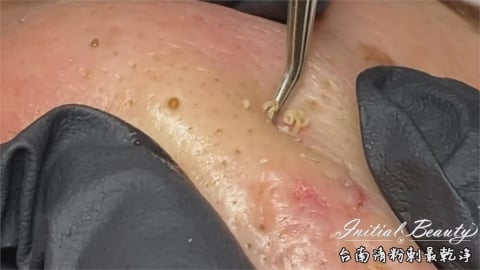 慎入片！陳年黑頭粉刺大軍移除術　美容師用力一擠「長條起司」瞬湧出