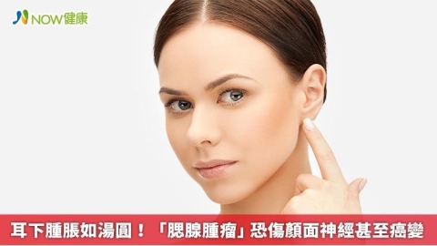 耳下腫脹如湯圓！ 「腮腺腫瘤」恐傷顏面神經甚至癌變