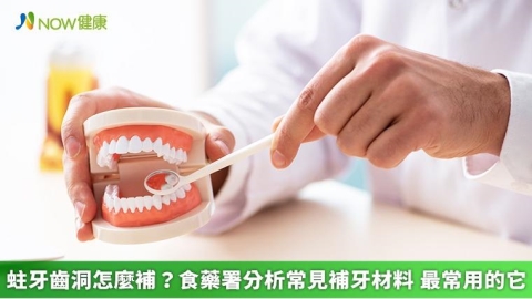 蛀牙齒洞怎麼補？食藥署分析常見補牙材料 最常用的它