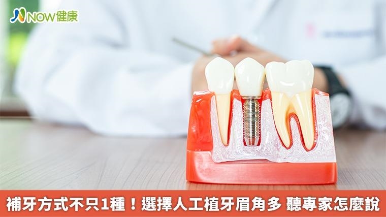 補牙方式不只1種!選擇人工植牙眉角多 聽專家怎麼說 補牙方式不只1種!選擇人工植牙眉角多 聽專家怎麼說