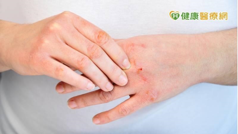 「這些習慣」當心害雙手粗糙！　食藥署授使用護手霜2秘訣