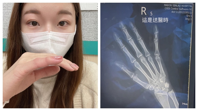 玩心臟病玩到進醫院!網紅奮力一戳「手指軟了」 X光照曝光半隻歪掉