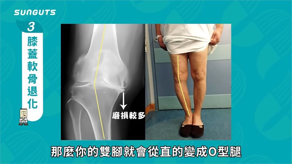 人近30 歲開始變矮?醫師指一壞習慣加速退化 直言: 身高少了8公分