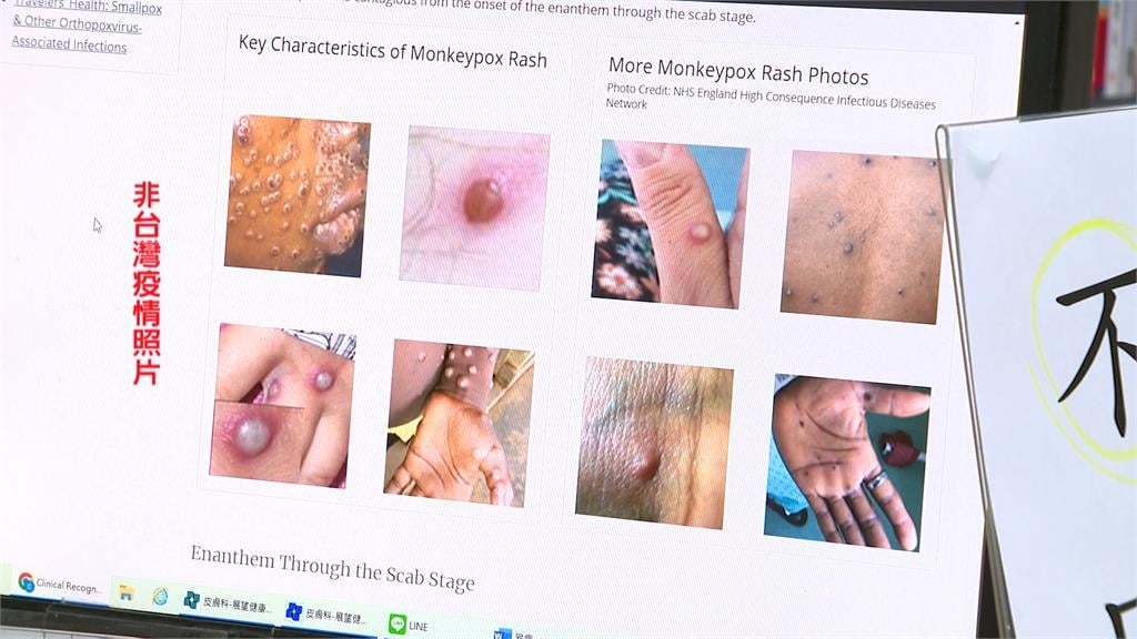 週三疫情再降9.3%　輕症免隔離最快下午宣布