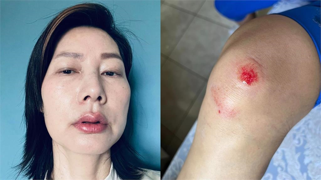 丁寧騎車慘摔臉超腫「嘴唇都血味」!曝「1驚人巧合」急澄清:不是家暴