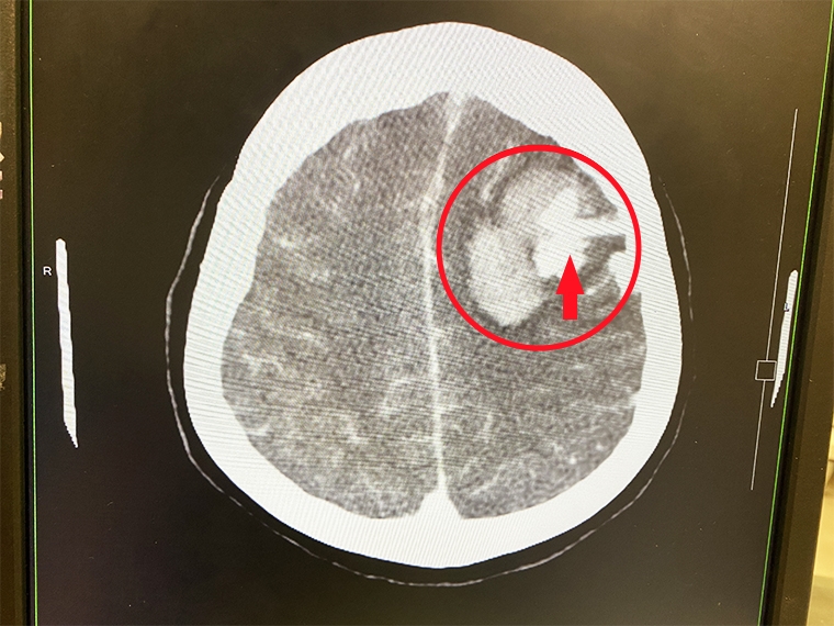 5旬突然昏迷檢查發現腦出血! 竟是先天血管病變釀禍