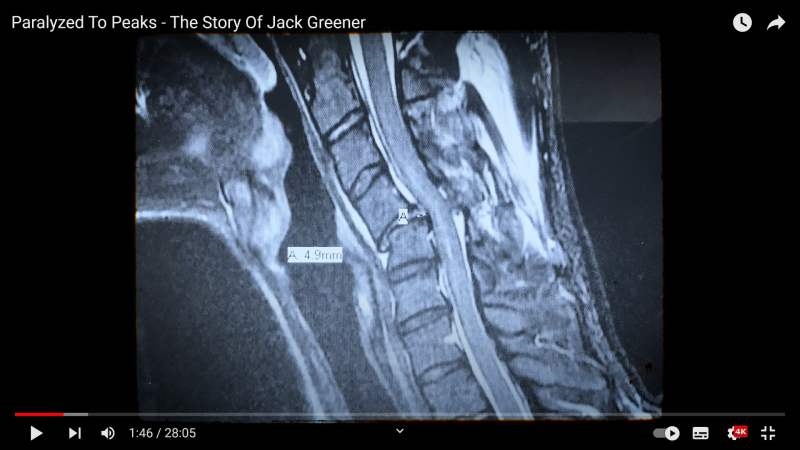 2競技運動造成頸椎損傷 運動員還能重返運動場嗎?醫師這樣說