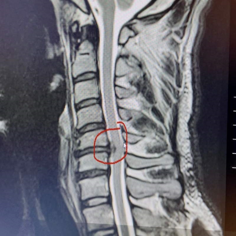 2競技運動造成頸椎損傷 運動員還能重返運動場嗎?醫師這樣說