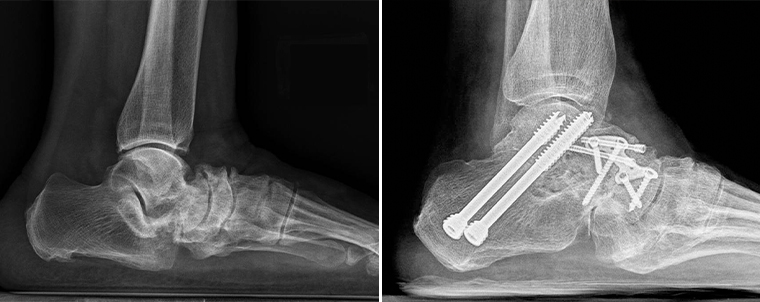 7旬翁左腳疼跛腳2年 竟是罕見足弓結構畸形另類扁平足