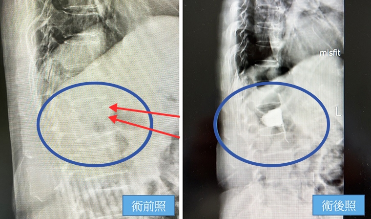 脊椎骨折被誤診為骨盆骨折 1手術治療搶救恢復行走力