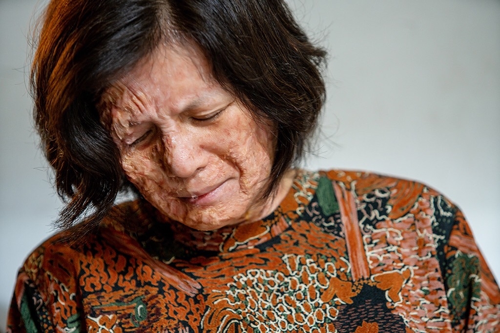 男星急速瘦身竟出現「橫紋肌溶解症」!伊正許願這角色結果被誤以為遭截肢?!