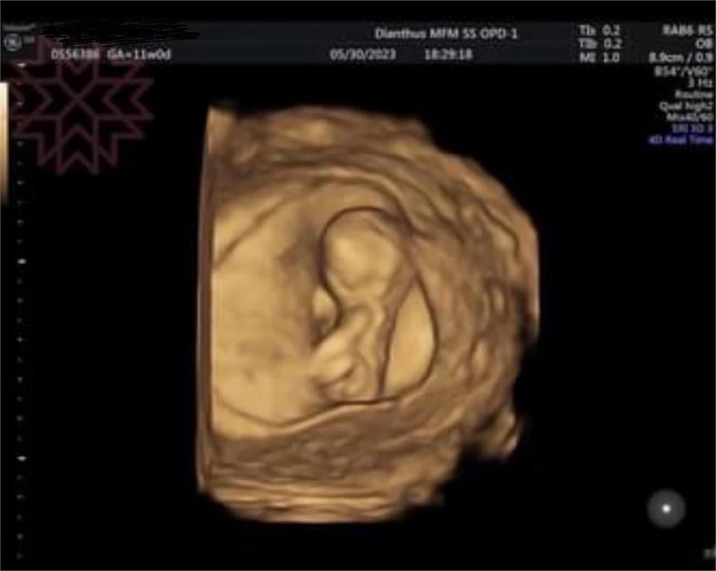 58歲楊繡惠曬超音波照！嗨喊「滿3個月再公開」網笑：爸爸是白雲？