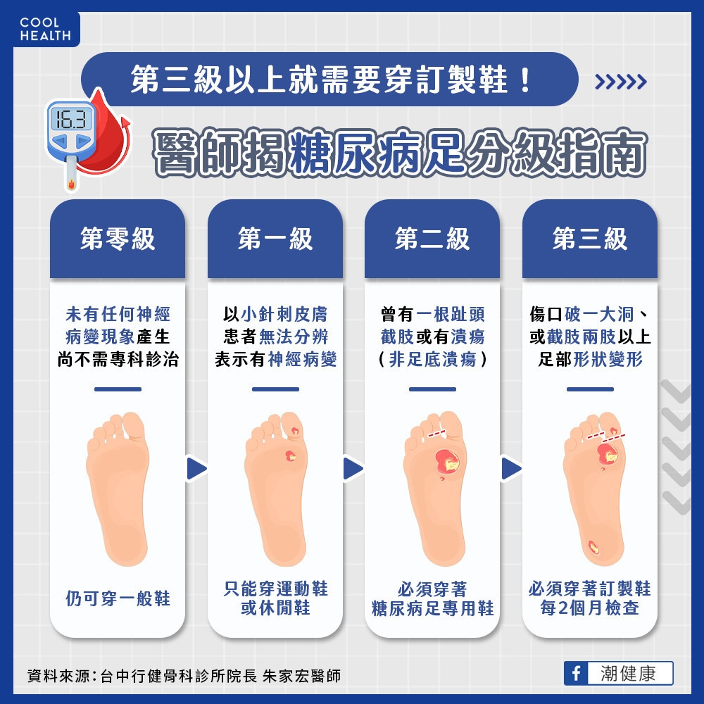 第三級以上就需要穿訂製鞋！  醫師揭糖尿病足分級指南