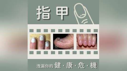 看指甲就知道你有病!「9種指甲異常」看圖秒懂 看指甲就知道你有病!「9種指甲異常」看圖秒懂