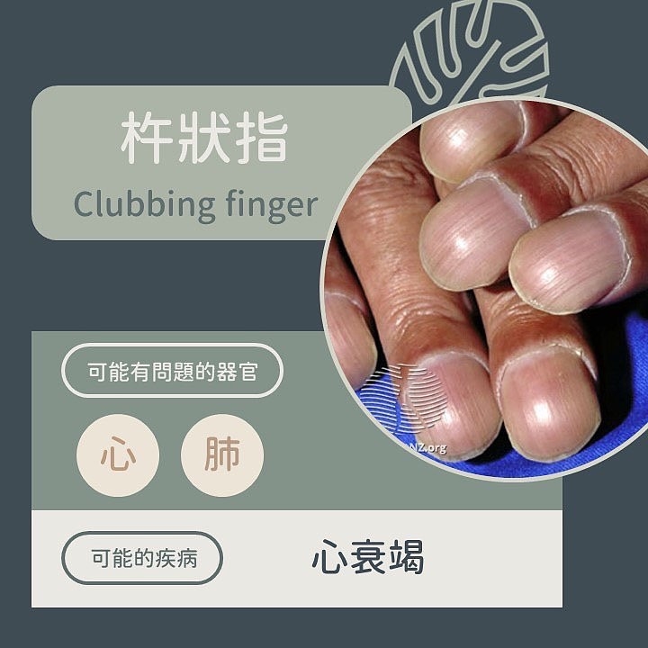 看指甲就知道你有病!「9種指甲異常」看圖秒懂