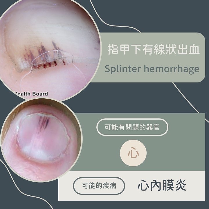 看指甲就知道你有病!「9種指甲異常」看圖秒懂