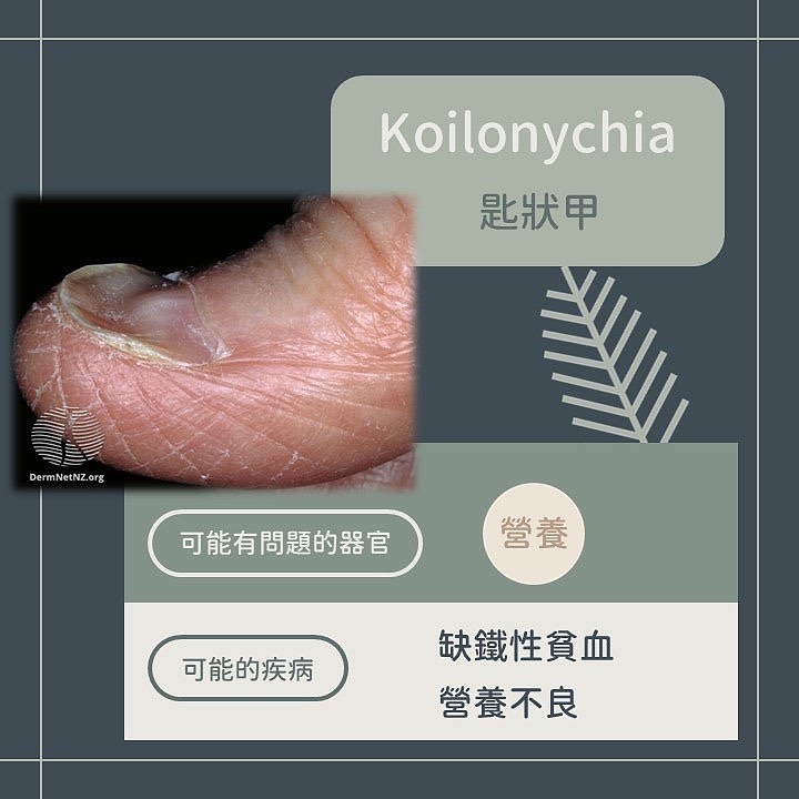 看指甲就知道你有病!「9種指甲異常」看圖秒懂