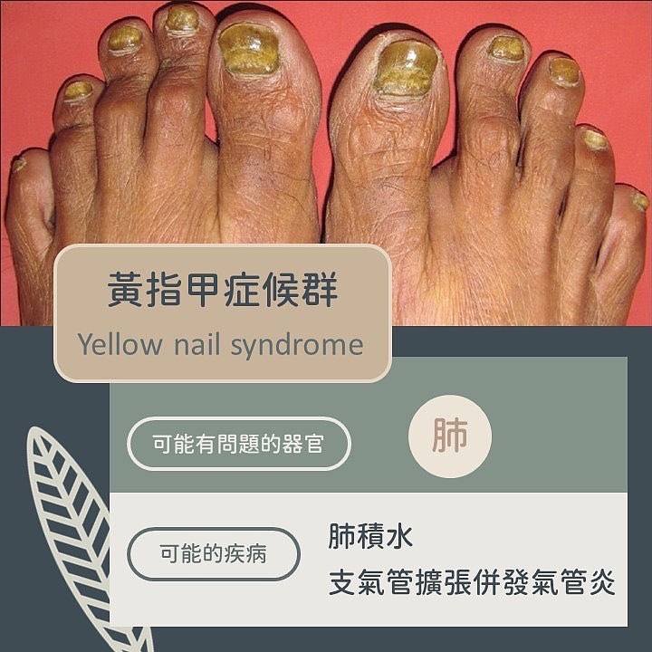 看指甲就知道你有病!「9種指甲異常」看圖秒懂
