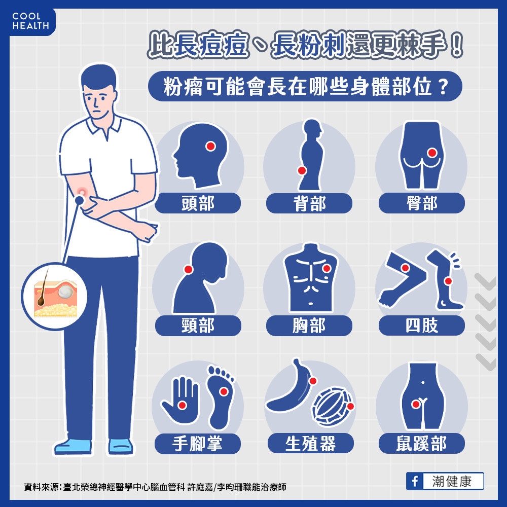 比粉刺、痘痘都還棘手！ 「粉瘤」長最大可達10公分？