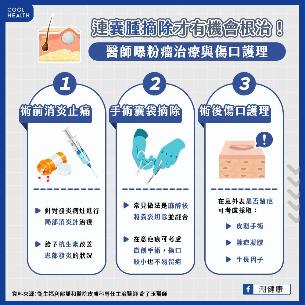 粉瘤如同皮膚「違章建築」  連「囊腫」一同摘除才有機會根治
