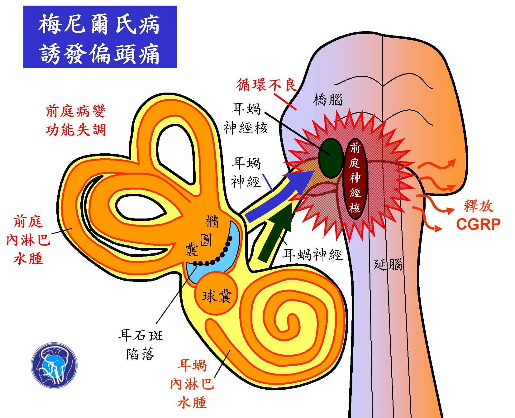 偏頭痛竟是梅尼爾氏病/症?醫指4常見情況,治療時別碰奶製品!