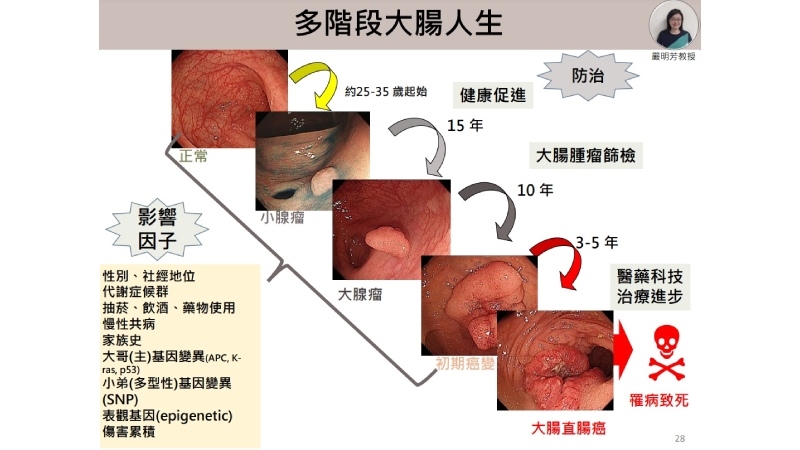 大腸直腸癌「三多」特色　AI「三段五級」精準防治