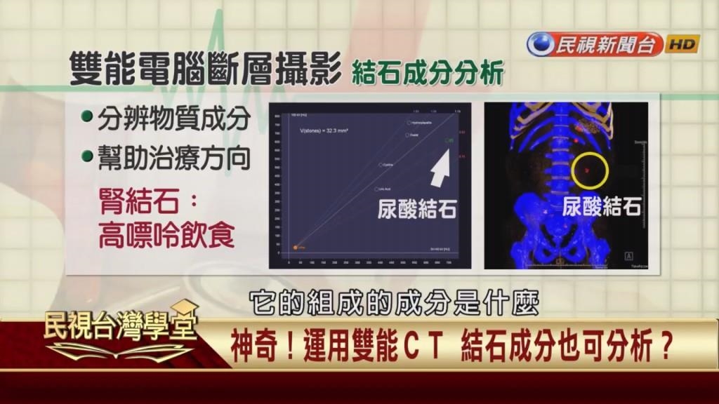 神奇！雙能電腦斷層能辦別結石成分　痛風也可進行診斷分析　