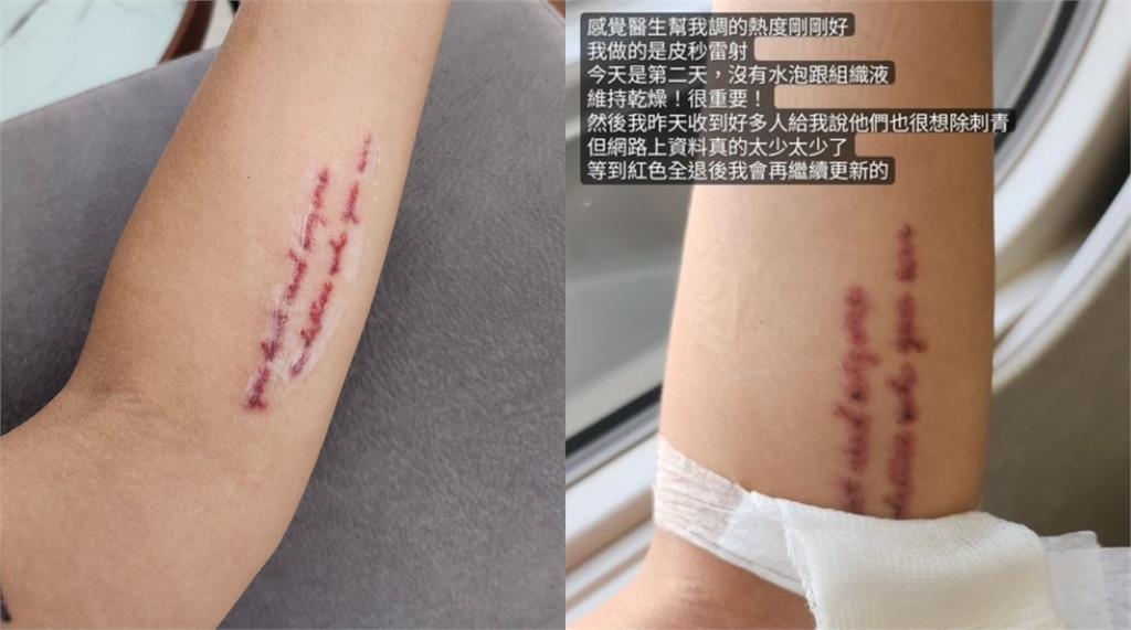 阿圓3度除刺青「驚悚傷口照」流出!親曝「這部位」超有感:像被火柴燙