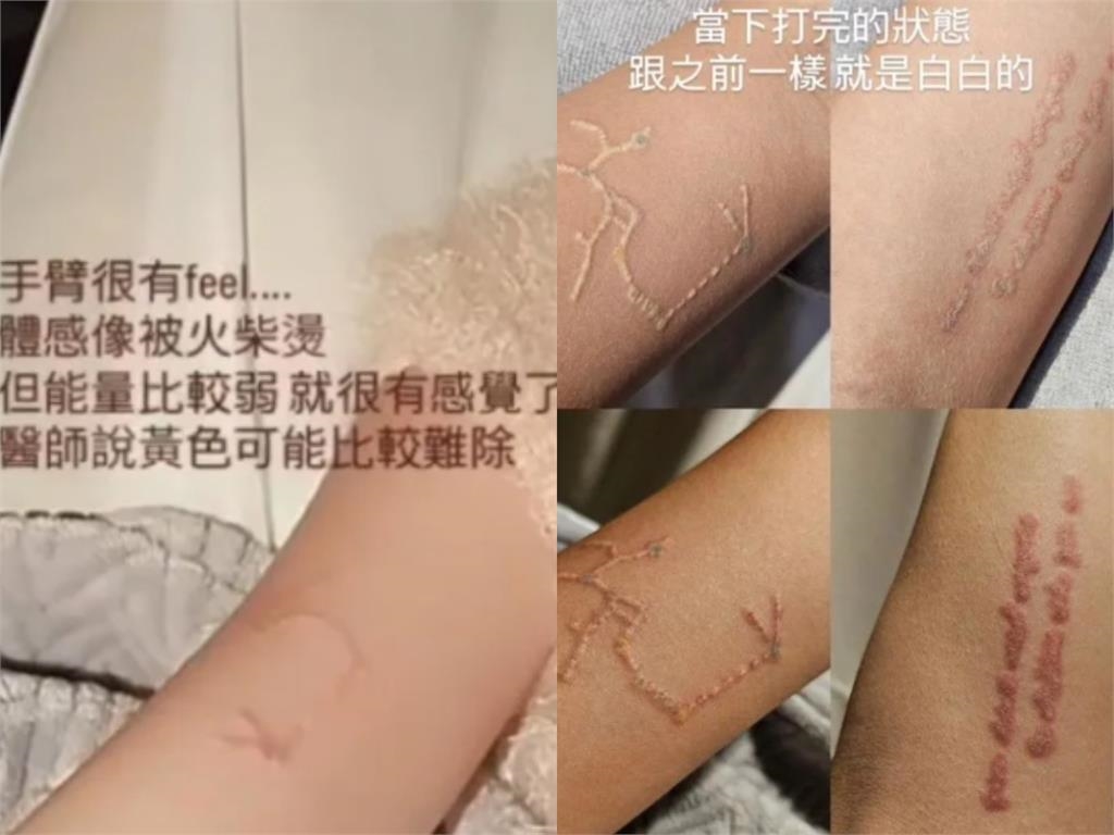 阿圓3度除刺青「驚悚傷口照」流出!親曝「這部位」超有感:像被火柴燙