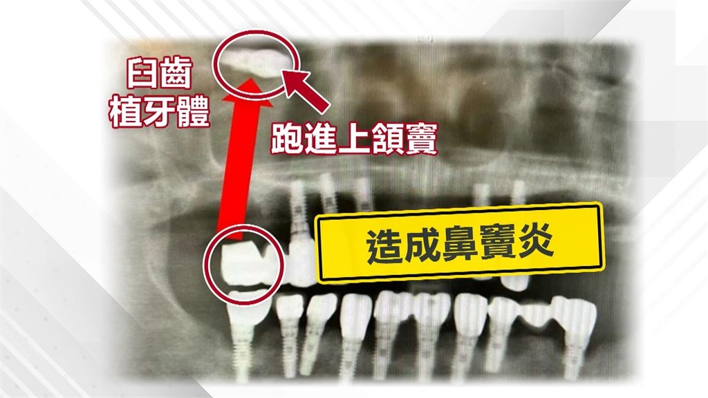 惱人!病患罹鼻竇炎無法根治 竟是植牙體掉進鼻竇腔
