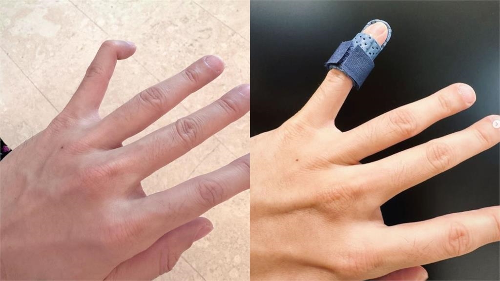 林俊傑手指「90度彎曲變形」畫面曝光!親曝受傷原因:希望只是惡作劇…