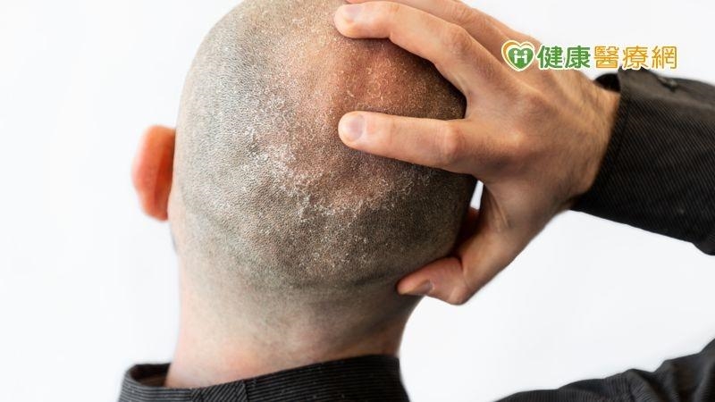 脂漏性皮膚炎脫屑又油膩？　中醫治療重清熱利濕、祛風止癢