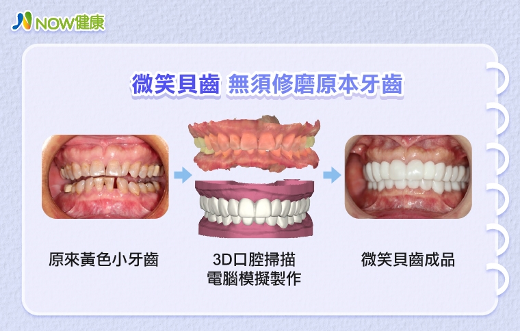 牙齒美容兼顧功能與美觀 客製化療程讓女企業家變年輕