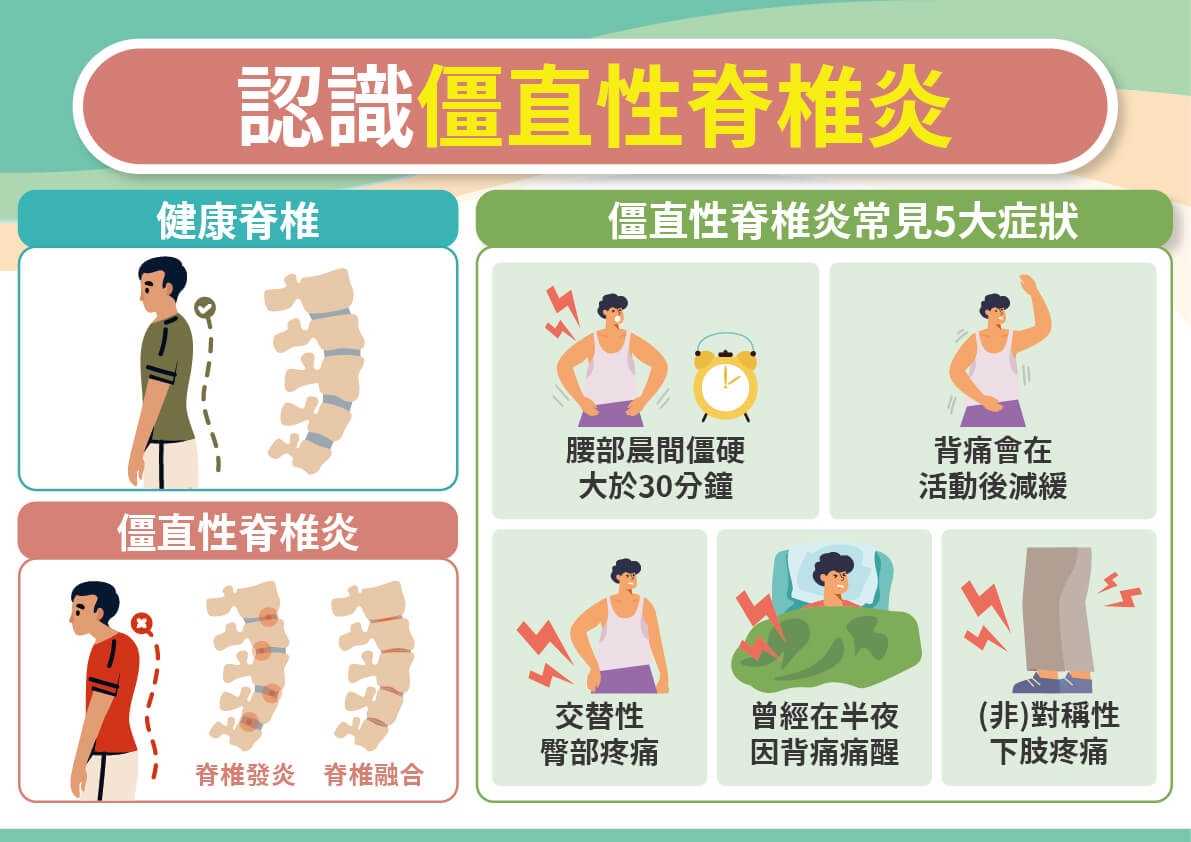 背「硬」如竹竿，僵直性脊椎炎當心6共病找上！口服標靶小分子藥物助早回人生不忍痛！