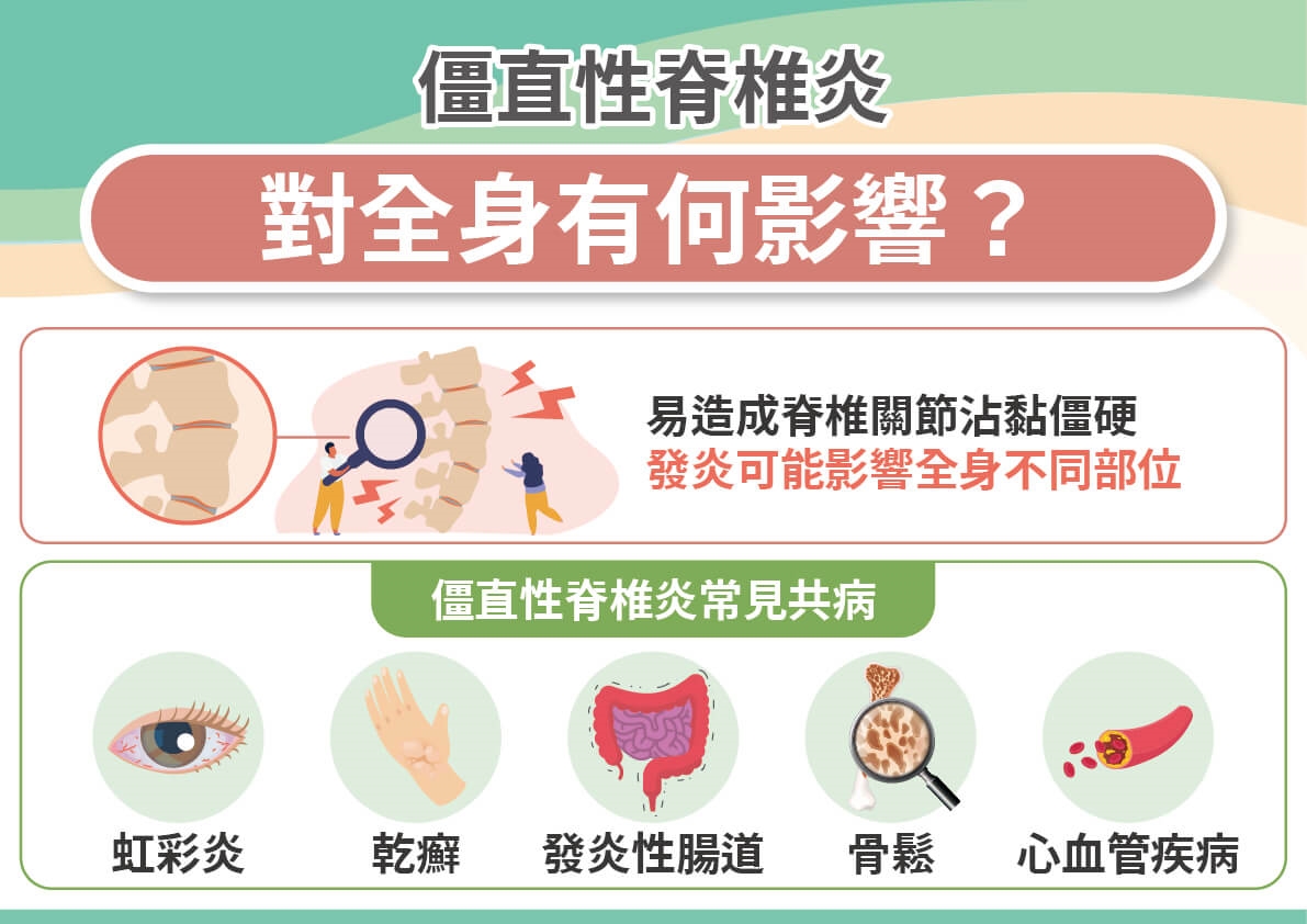 背「硬」如竹竿，僵直性脊椎炎當心6共病找上！口服標靶小分子藥物助早回人生不忍痛！