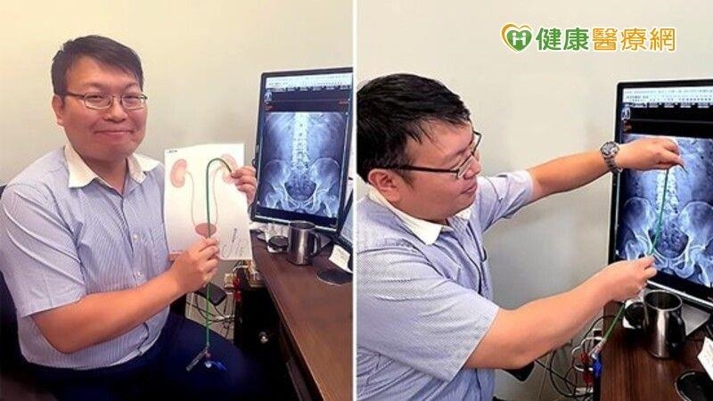 腎結石治療　8公分結石也能如吸塵器般「吸」除