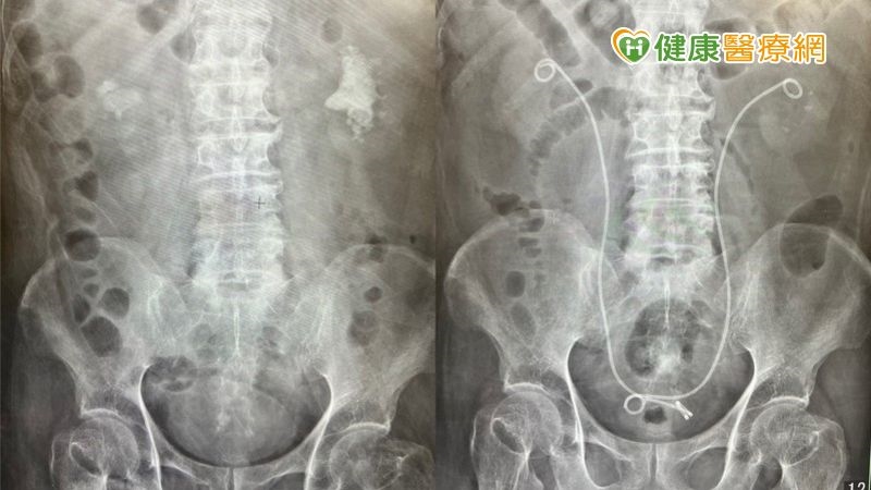 腎結石治療 8公分結石也能如吸塵器般「吸」除