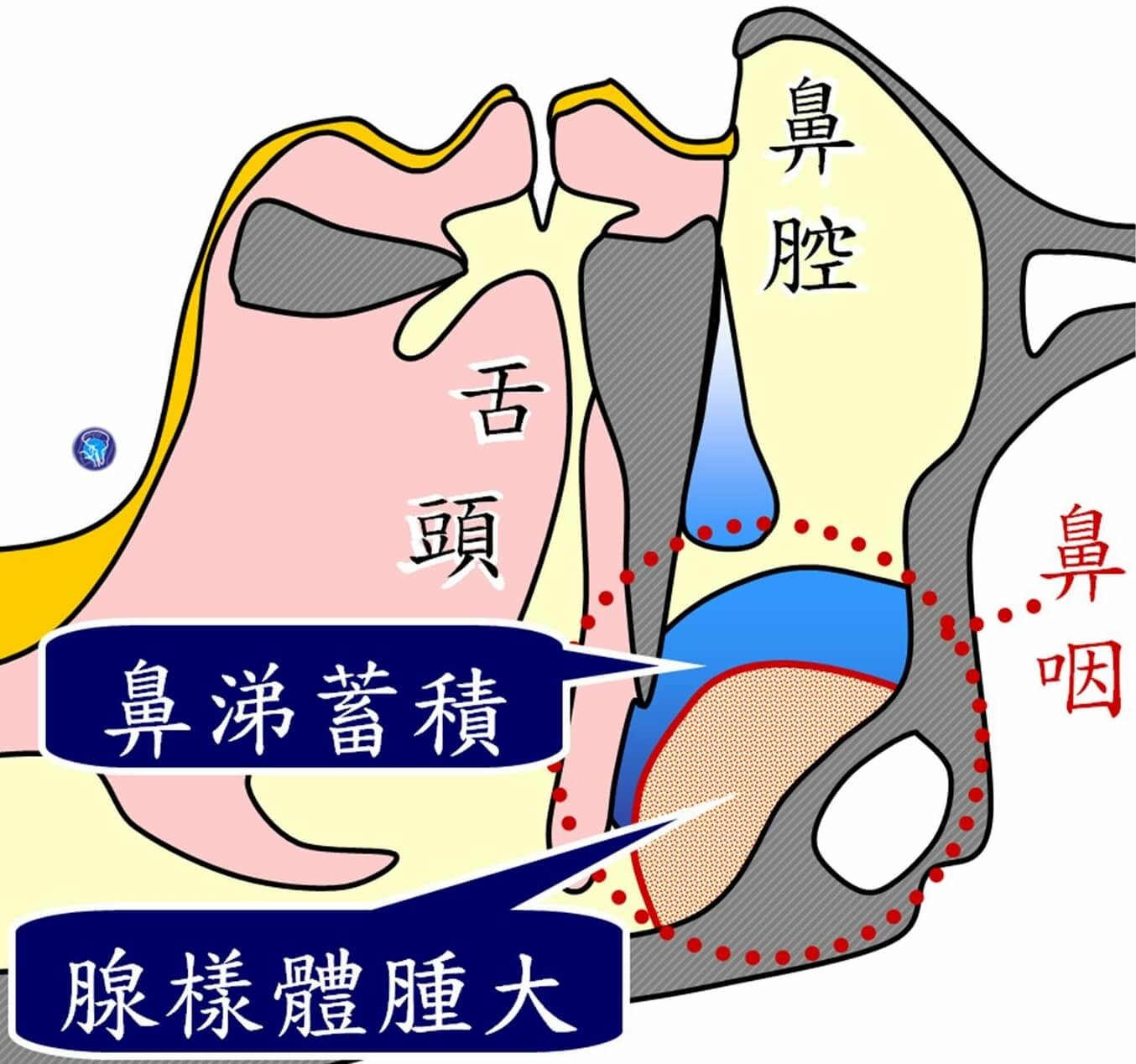 夜驚症發作以為卡到陰！8月男嬰發出呼嚕聲竟發現鼻竇炎