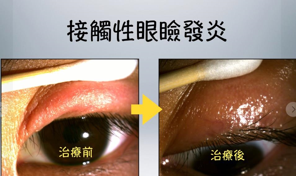 女子眼皮腫到如「香腸」!醫提醒:眼部彩妝買來先做「1事」較保險