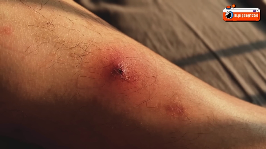 疑飯店衛生不佳!他腿部不明紅種 揭病況嘆:住宿省的錢都拿去看醫生