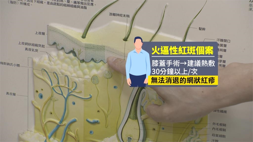 寒流報到!保暖物品勿長時間使用 恐引發「火逼性紅斑」有致癌風險