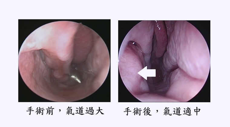 鼻腔手術後還是鼻塞？恐是空鼻症所致 可靠這手術改善