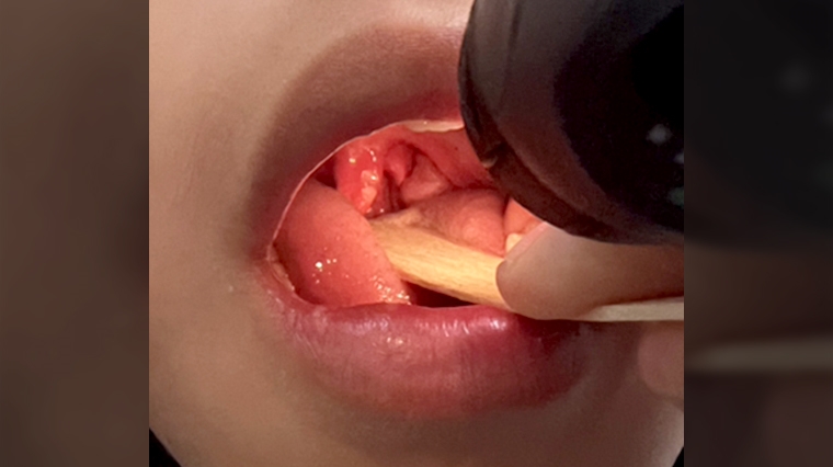 腸病毒威脅不分季節 病童高燒超過39度、皮膚長滿紅疹