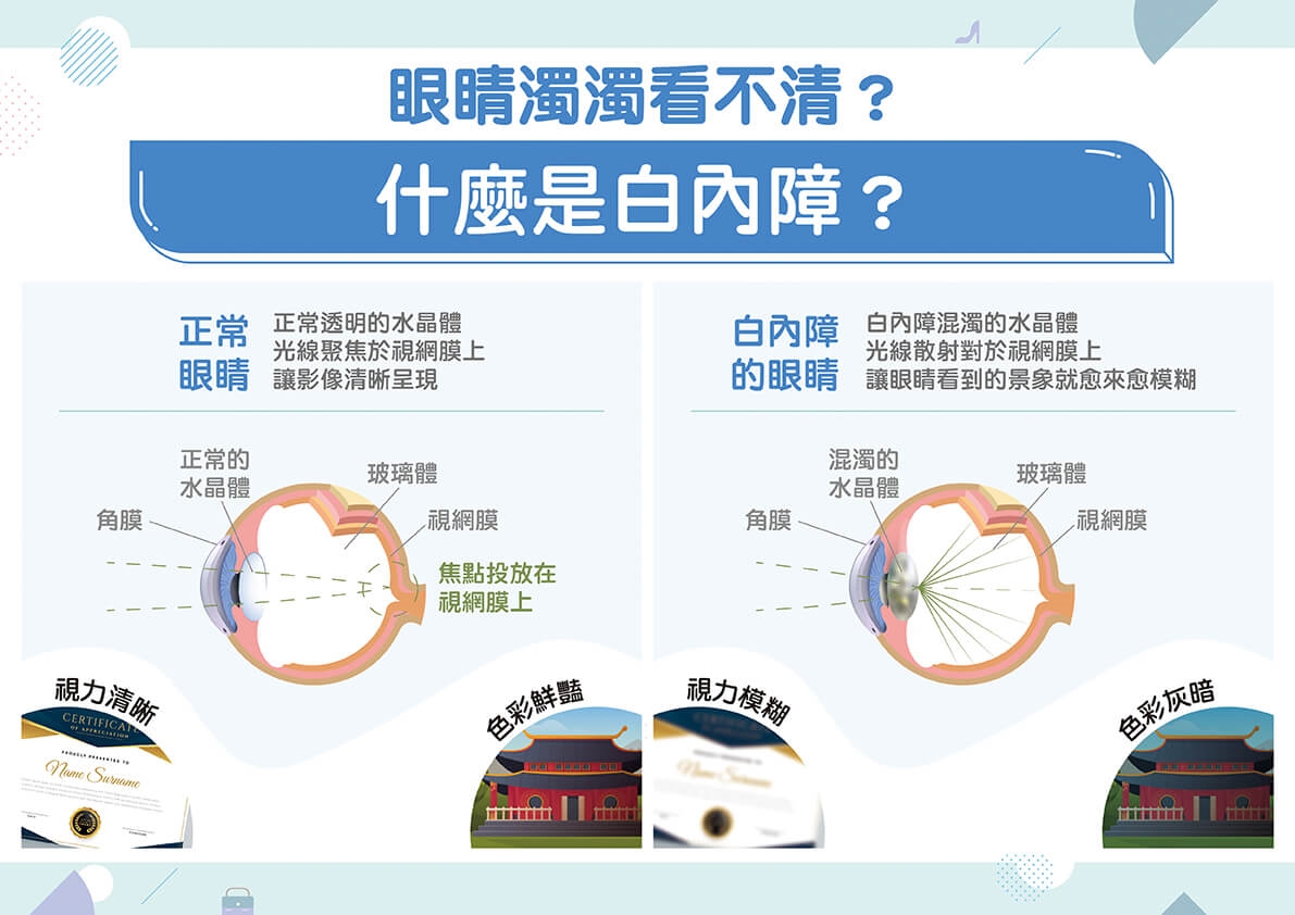白內障提早來報到怎麼辦？遵循「這撇步」挑人工水晶體！