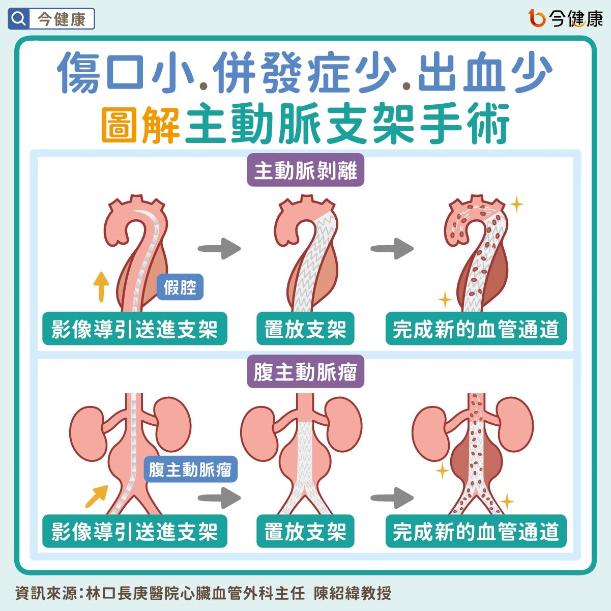 病人最常霧煞煞的主動脈疾病──沒症狀還是要治療？主動脈瘤不是腫瘤？主動脈支架手術是什麼？