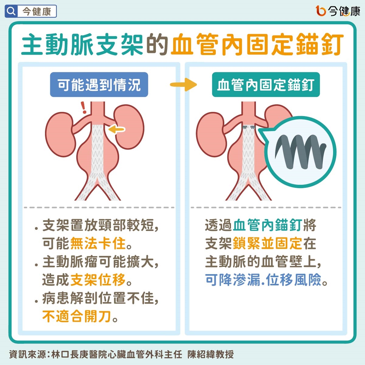 病人最常霧煞煞的主動脈疾病──沒症狀還是要治療？主動脈瘤不是腫瘤？主動脈支架手術是什麼？